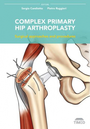 Complex primary hip arthroplasty